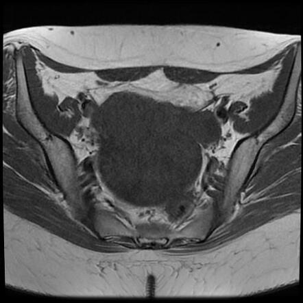 Ovarian Torsion Image Radiopaedia Org