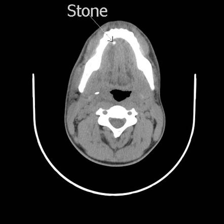 Acute Submandibular Sialadenitis Secondary To Ductal Stone Radiology