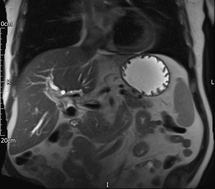 Mirizzi Syndrome Radiology Case Radiopaedia Org