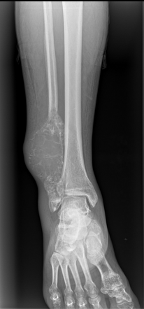 Osteosarcoma Radiology Case Radiopaedia Org