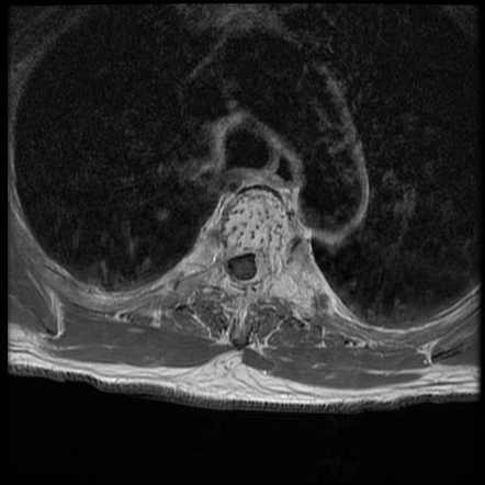 Aggressive Vertebral Hemangioma Radiology Reference Article