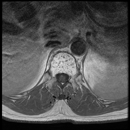 Aggressive Vertebral Hemangioma Image Radiopaedia Org