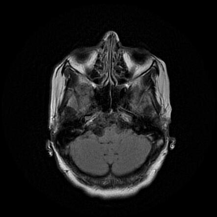 Epidermoid Cyst Cerebellopontine Angle Image Radiopaedia Org