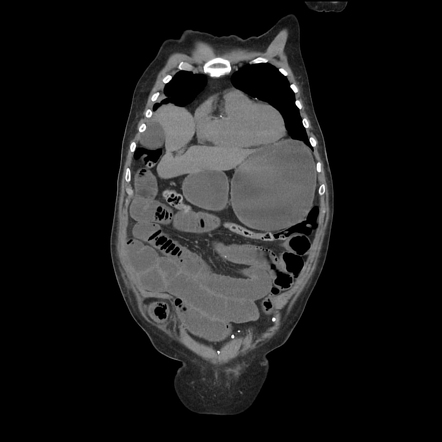 Incarcerated Spigelian Hernia Radiology Case Radiopaedia Org