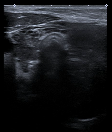 Primary Thyroid Lymphoma Image Radiopaedia Org