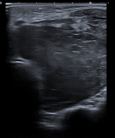 Primary Thyroid Lymphoma Image Radiopaedia Org