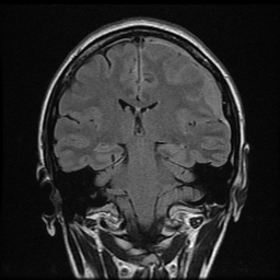 Dural Lymphoma Image Radiopaedia Org