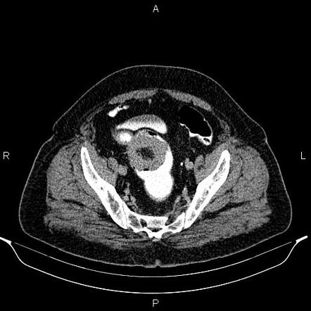 Colocolic Intussusception Due To The Tumoral Infiltration Radiology