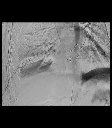 Extrapleural Hematoma Due To Intercostal Artery Injury Image