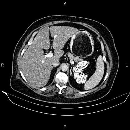 Giant Gastric Lipoma Image Radiopaedia Org