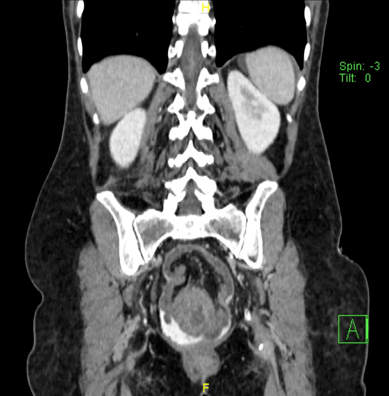 Colorectal Intussusception Image Radiopaedia Org