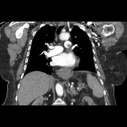 Pulmonary Embolism Image Radiopaedia Org