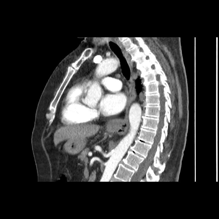 Pulmonary Embolism Image Radiopaedia Org