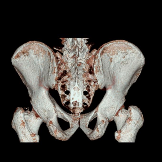 Incarcerated Femoral Hernia Due To Foreign Body Image Radiopaedia Org