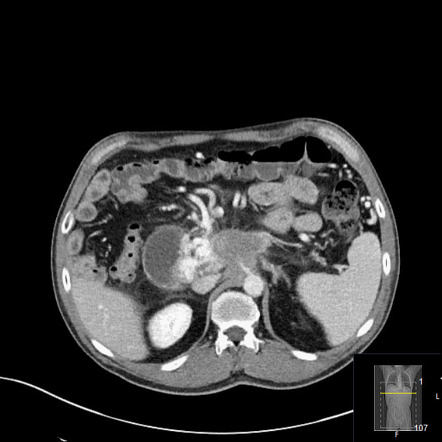 New Classification Of Locally Advanced Pancreatic Cancer Off