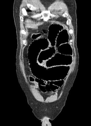 Perforated Acute Appendicitis With Small Bowel Obstruction Radiology