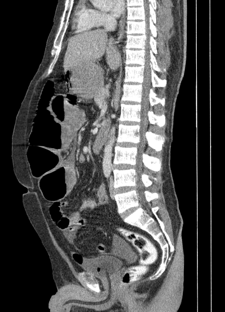 Acute Perforated Appendicitis With Small Bowel Obstruction Image