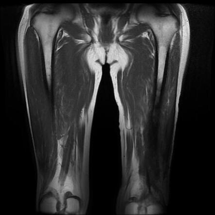 Chronic Osteomyelitis Distal Femur Image Radiopaedia Org