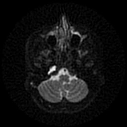 Cholesterol Granuloma Petrous Apex Image Radiopaedia Org