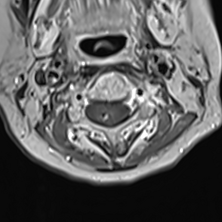 Cavernoma Cervical Spine Radiation Induced Image Radiopaedia Org