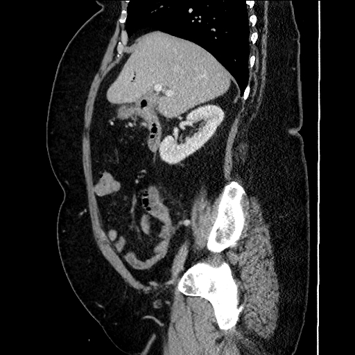 Cholecystoduodenal Fistula Image Radiopaedia Org