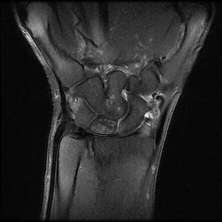 Kienböck disease Image Radiopaedia org