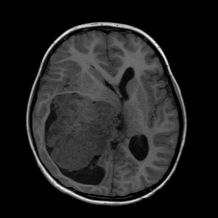 Choroid Plexus Carcinoma Image Radiopaedia Org