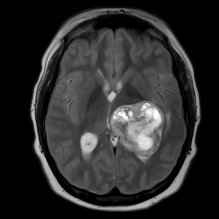 Glioblastoma IDH Wildtype Pediatric Radiology Case Radiopaedia Org