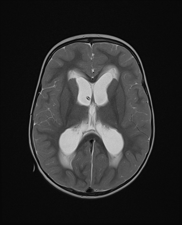 CNS Tumor With BCOR Internal Tandem Duplication Radiology Case