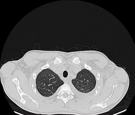 Interstitial Pulmonary Edema Radiology Case Radiopaedia Org