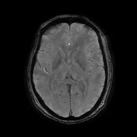 Bilateral Hypertrophic Olivary Degeneration Image Radiopaedia Org