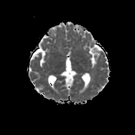 Septo Optic Dysplasia Image Radiopaedia Org