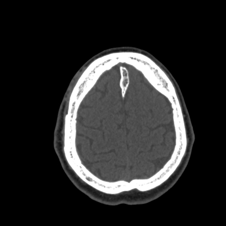 Ossification Of The Falx With Fatty Marrow Radiology Case