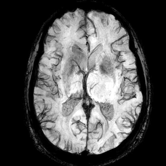 Thalamic Glioblastoma Image Radiopaedia Org