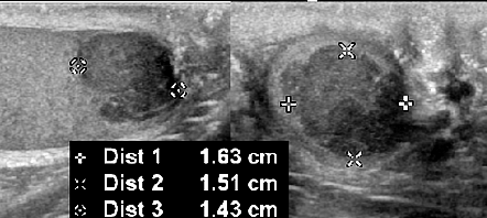 Testicular Seminoma Image Radiopaedia Org