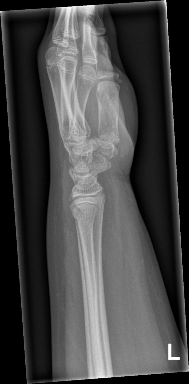 Distal Radius Buckle Fracture With Ulnar Styloid Fracture Image Radiopaedia Org