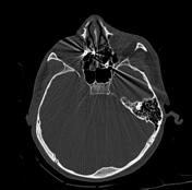 CT Artifacts Radiology Reference Article Radiopaedia Org