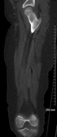 Unicameral Bone Cyst With Fracture Femur Image Radiopaedia Org