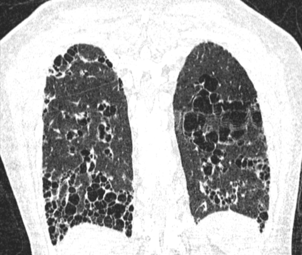 Rheumatoid Arthritis Associated Interstitial Lung Disease UIP Pattern