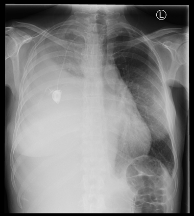 Pleural Effusion Metastatic Breast Cancer Radiology Case