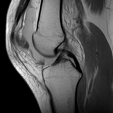 Transient Lateral Patellar Dislocation With Displaced Osteochondral