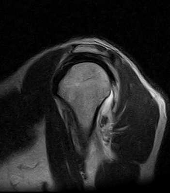 Posterior Shoulder Dislocation With Reverse Hill Sachs Defect And