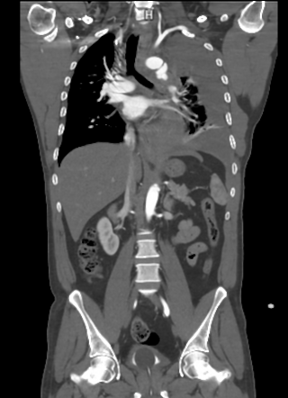 Post Traumatic Aortic Pseudoaneurysm Image Radiopaedia Org