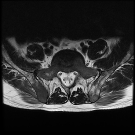 Sickle Cell Disease Skeletal Image Radiopaedia Org