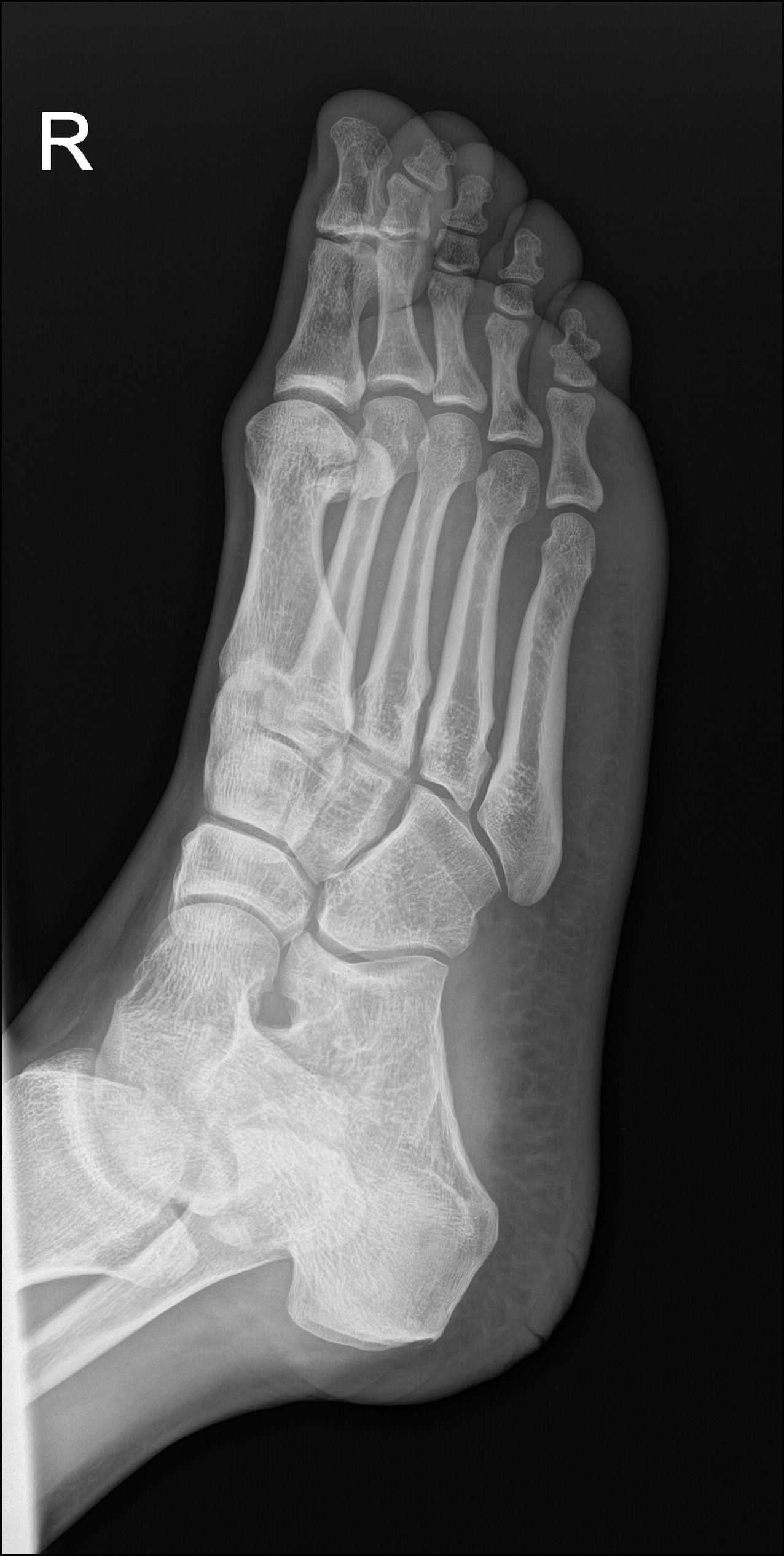 Accessory Bone At The Base Of The Distal Phalanx Of The First Toe