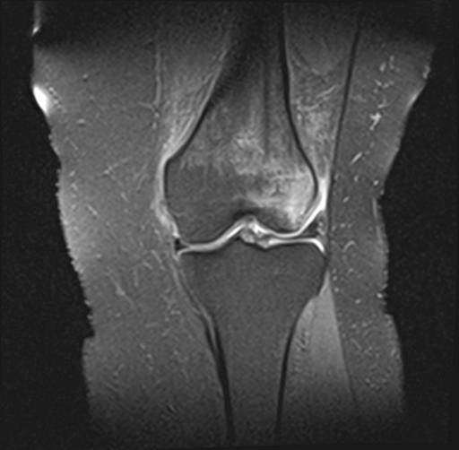 Transient Lateral Patellar Dislocation Image Radiopaedia Org