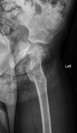 Trochanteric Fracture Radiology Reference Article Radiopaedia Org