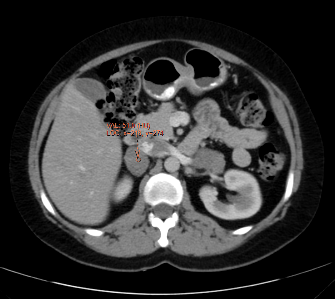 Bilateral Macronodular Adrenal Cortical Hyperplasia Image