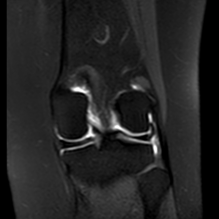 Normal Mri Arthrography Of The Knee Radiology Case Radiopaedia Org