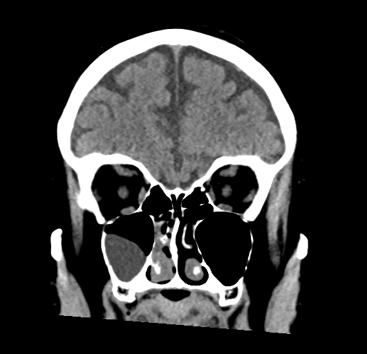 Mucous Retention Cyst Image Radiopaedia Org